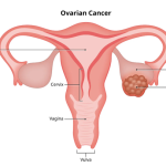 Gejala Dini Kanker Yang Sering Terlewatkan