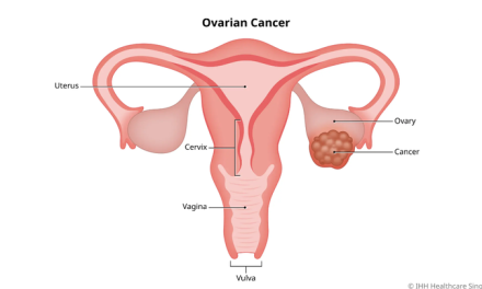 Gejala Dini Kanker Yang Sering Terlewatkan