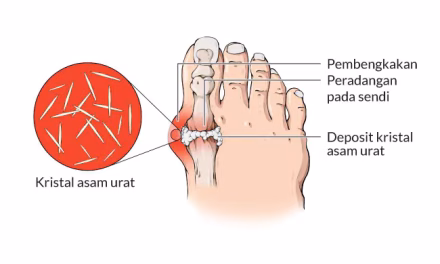 Asam Urat: Penyebab, Gejala, Dan Cara Menjaga Pola Hidup